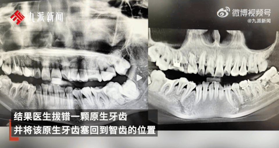 女子疑因"拔错牙又被塞回"坠楼身亡，多方回应